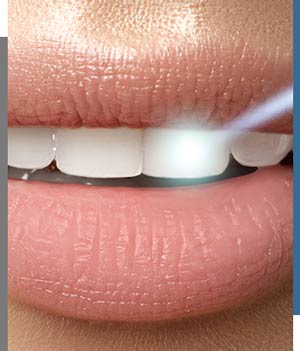 Laser Periodontal Therapy - Bay Dental Family Dentistry and Orthodontics in Santa Ana, CA