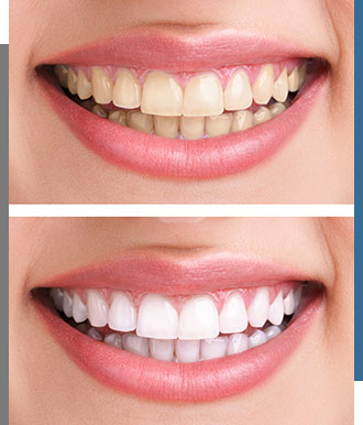 Smile Gallery - Bay Dental Family Dentistry and Orthodontics in Santa Ana, CA