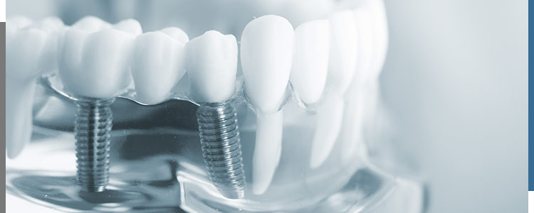 Dental implants near me