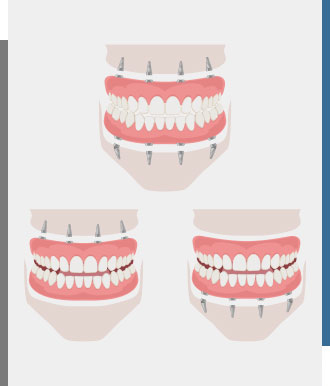 All-On-4® Dental Implants - Bay Dental Family Dentistry and Orthodontics in Santa Ana, CA