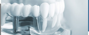 All-On-4® Dental Implants Specialist Near Me in Santa Ana, CA