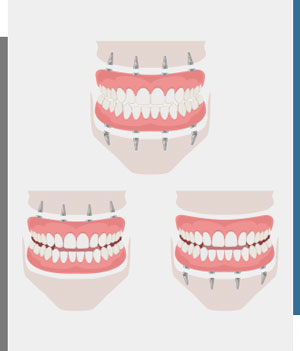 All-On-4® Dental Implants - Bay Dental Family Dentistry and Orthodontics in Santa Ana, CA