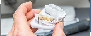 Dental Bridges Cost Near Me in Santa Ana, CA