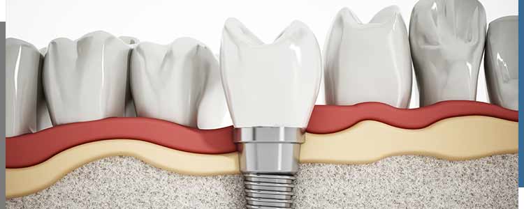 Dental Implants Cost Near Me in Santa Ana, CA