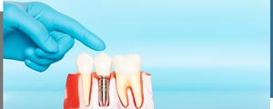 Affordable Dental Implants Specialist Near Me in Santa Ana, CA