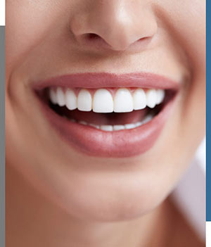 Porcelain Veneers - Bay Dental Family Dentistry and Orthodontics in Santa Ana, CA