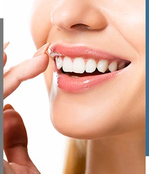 Charisma Chairside Whitening - Bay Dental Family Dentistry and Orthodontics in Santa Ana, CA