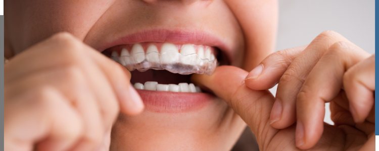 Top Clear Aligners Specialist Near Me in Santa Ana, CA Top Clear Aligners Specialist Near Me in Santa Ana, CA