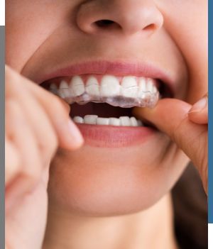 Clear Aligners - Bay Dental Family Dentistry and Orthodontics in Santa Ana, CA