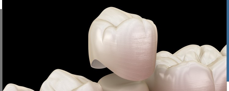 Dental Crown Procedure Specialist Near Me in Santa Ana, CA Dental Crown Procedure Specialist Near Me in Santa Ana, CA