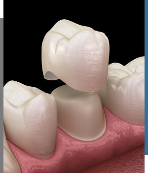 Dental Crown - Bay Dental Family Dentistry and Orthodontics in Santa Ana, CA